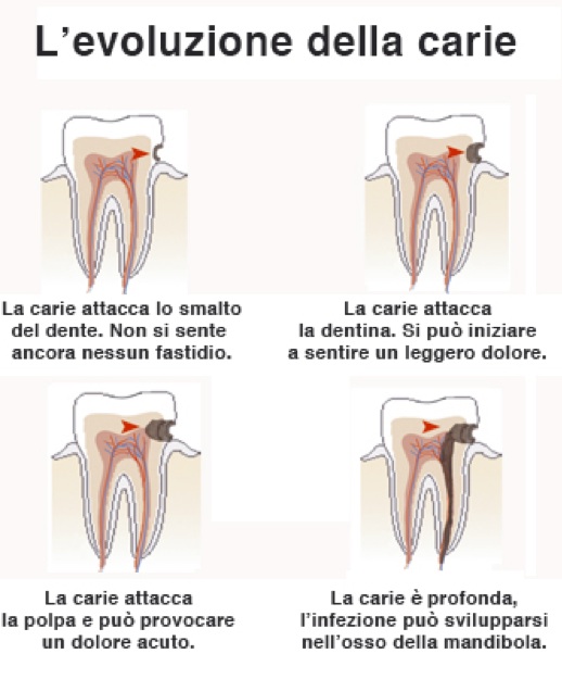 evoluzione carie